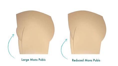 large pubic mound|Enlarged Mons Pubis (Excessive Pubic Fat) .